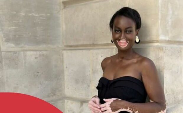 PHOTO – Miss France 2024 : qui est Estelle Mendy, cette candidate atteinte de vitiligo ?